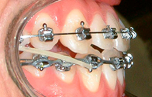 ortodoncia-cirugia-ortognática
